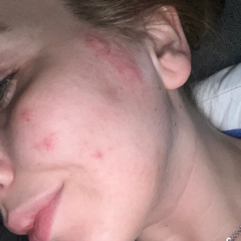 Loreal Paris Koyu Leke Karşıtı Güneş Kremi Sivilce Yapıyor!