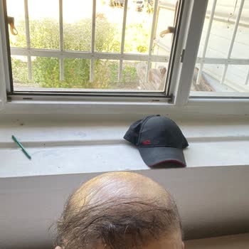 Serkan Aydın Saç Ekimi Saç Ekimi Hatası