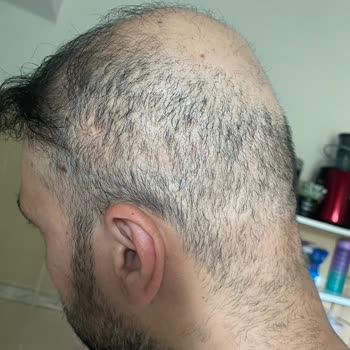 Serkan Aydın Saç Ekimi Saç Ekimi Hatası