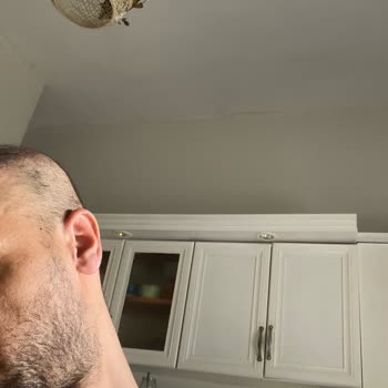 Serkan Aydın Saç Ekimi Saç Ekimi Hatası