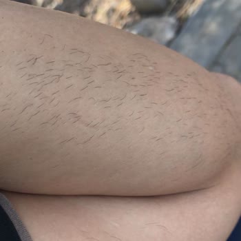 Enza Güzellik Merkezleri Epilasyon Hizmetinde Yaşanan Sorunlar Ve Memnuniyetsizlik