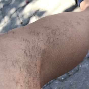 Enza Güzellik Merkezleri Epilasyon Hizmetinde Yaşanan Sorunlar Ve Memnuniyetsizlik