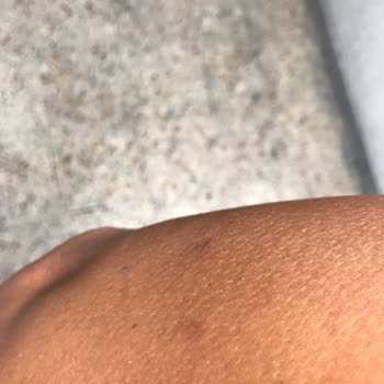 Enza Güzellik Merkezleri Epilasyon Hizmetinde Yaşanan Sorunlar Ve Memnuniyetsizlik