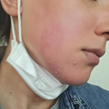 Dilan Polat Hautpflegefehler Verbrennung durch falsche Behandlung