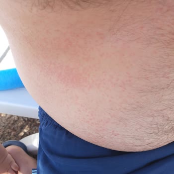 Nivea Pişmanlıktır, Alerji Sahibi Yapıyor, Tatili Mahvediyor.
