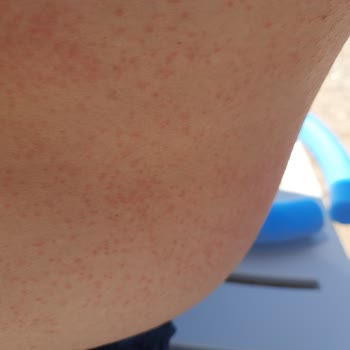 Nivea Pişmanlıktır, Alerji Sahibi Yapıyor, Tatili Mahvediyor.