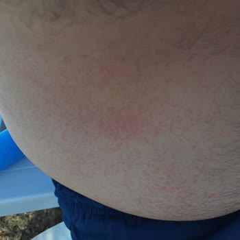 Nivea Pişmanlıktır, Alerji Sahibi Yapıyor, Tatili Mahvediyor.