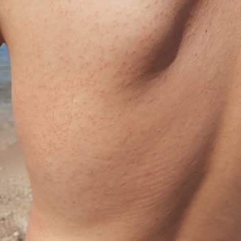 Nivea Pişmanlıktır, Alerji Sahibi Yapıyor, Tatili Mahvediyor.