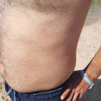 Nivea Pişmanlıktır, Alerji Sahibi Yapıyor, Tatili Mahvediyor.