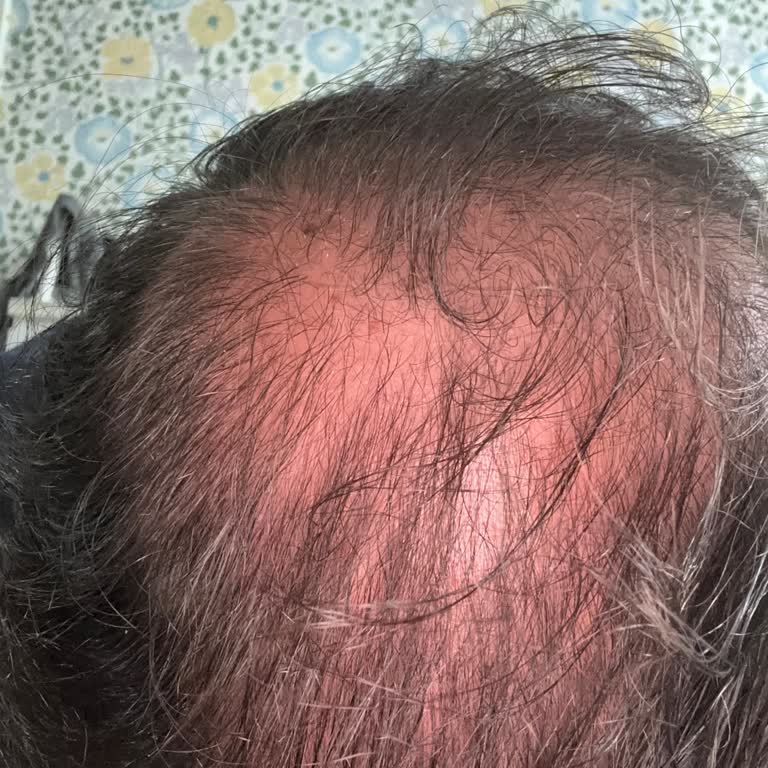 Özel Esteliv Polikliniği Saç Ekimi İşlemi