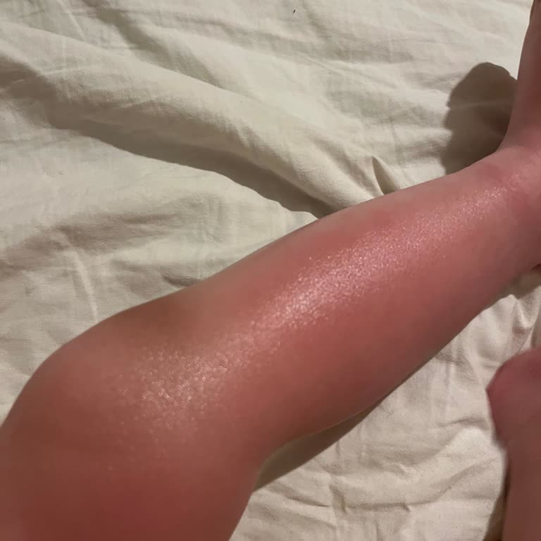 Siveno Güneş Kremi Yüzünden Bebeğimin Bacakları Yandı