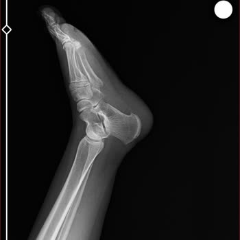 Korkuteli Belediyesi Park Çıkışındaki Açık Drenaj Kanalı Sorunu