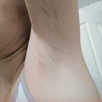 Aysha Beauty Lazer Yanığı