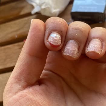 Asmina Güzellik Tırnağımı Çıkarırken Etimle Birlikte Koparttılar