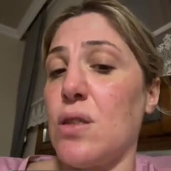 Bioderma Yüzümde Yanma Yaptı!