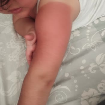 BİM Güneş Kremi Mağduriyeti