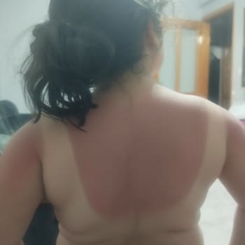 BİM Güneş Kremi Mağduriyeti