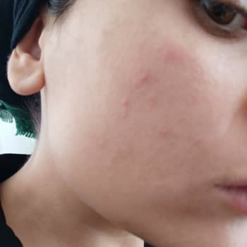 The Purest Solutions Ürünleri Sivilcelenme Yapıyor