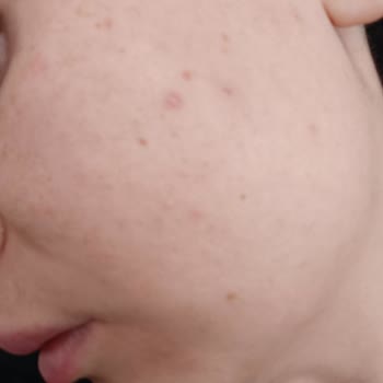 The Purest Solutions Ürünleri Sivilcelenme Yapıyor