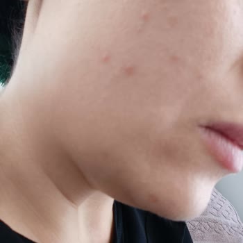 The Purest Solutions Ürünleri Sivilcelenme Yapıyor