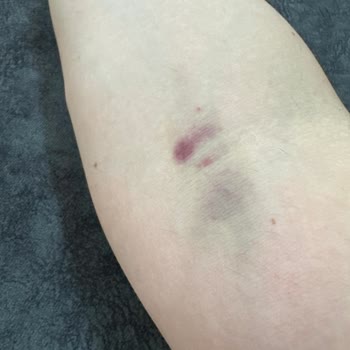 Memorial Hastanesi Memorial Diyarbakır Haksız Ücret Talebi