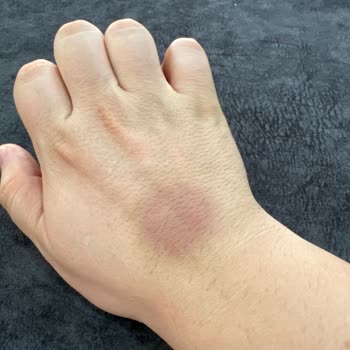 Memorial Hastanesi Memorial Diyarbakır Haksız Ücret Talebi