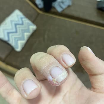 Derma Güzellik Atakent Tırnaklarım İltihap Kaptı!