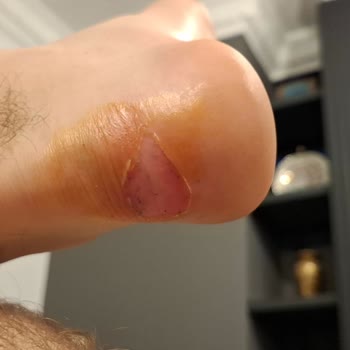 UKİ Ayakkabı Yara Yaptı