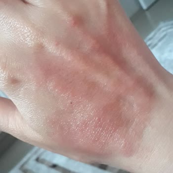 Maruderm Güneş Kremi Güneşten Korumuyor Cildi Tahriş Ediyor