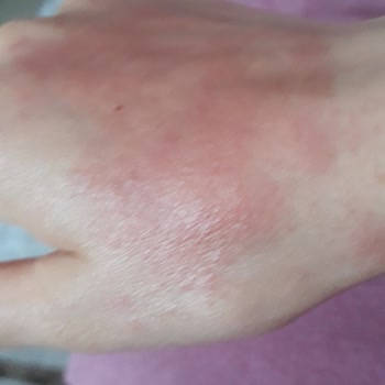 Maruderm Güneş Kremi Güneşten Korumuyor Cildi Tahriş Ediyor