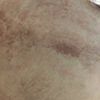 Veet Tüy Dökücü Krem Göğüs Bölgesinde Tahriş Ve Yanma Sorunu