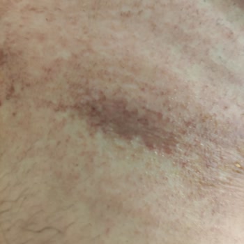 Veet Tüy Dökücü Krem Göğüs Bölgesinde Tahriş Ve Yanma Sorunu