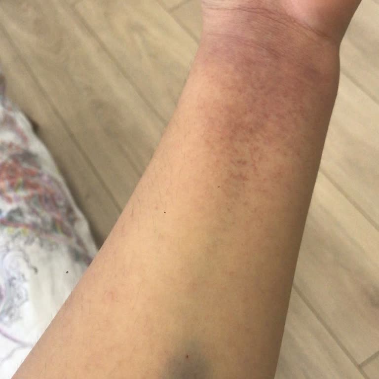 Dalan Şakayıklı Dus Jeli Alerji Yapıyor