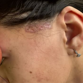 Aris Güzellik Merkezleri Lazer Yanığı