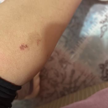 Aris Güzellik Merkezleri Lazer Yanığı