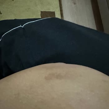 Aris Güzellik Merkezleri Lazer Yanığı