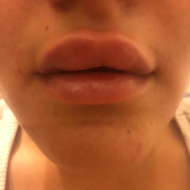 Antalya Zeynep Bulut Beauty Dudak Dolgusu Yamuk İşlem!