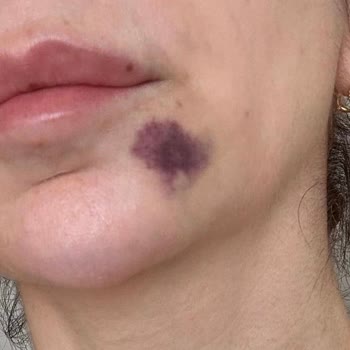 Op. Dr. Esra Çelik Şenel Ablamın Yüzünü Mahvetti