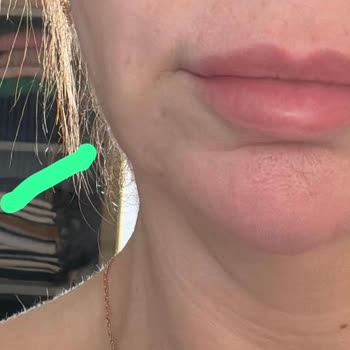 Op. Dr. Esra Çelik Şenel Ablamın Yüzünü Mahvetti