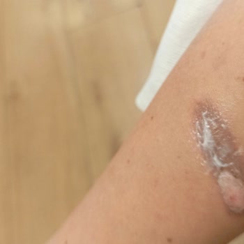 Anatolia Güzellik Merkezi Yanık Kolum Halini Görün