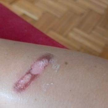 Anatolia Güzellik Merkezi Yanık Kolum Halini Görün