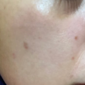 Narma Beauty Başarısız Ben Silme İşlemi