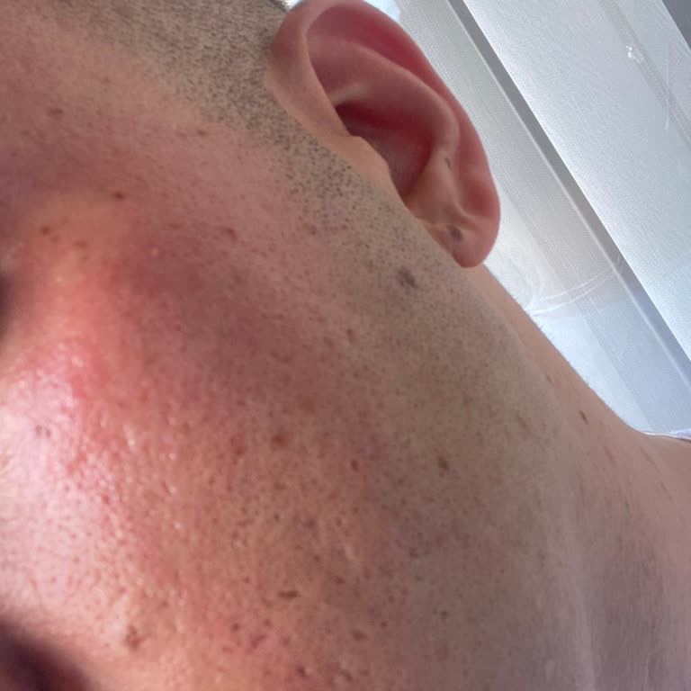 Sebamed Şampuan Yüzümü Yaktı