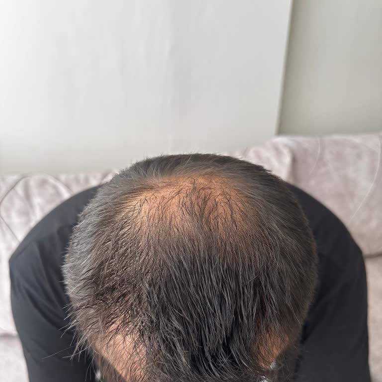 Estetik International Bursa Saç Ekimi Mağduriyeti