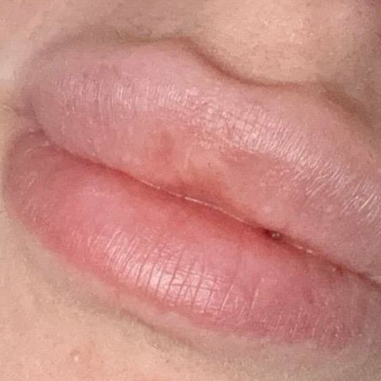 Elasty Dolgu Bıyığıma Taştı