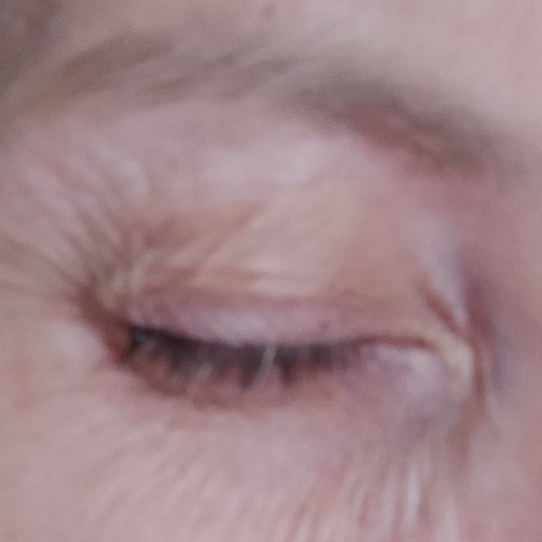 Estpoint Bursa Şubesinde Yapılan Botoks