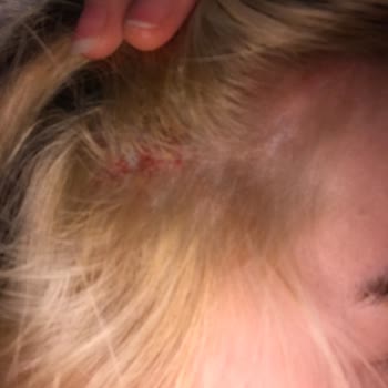 Palette Saç Boyası Saç Derimi Yaktı