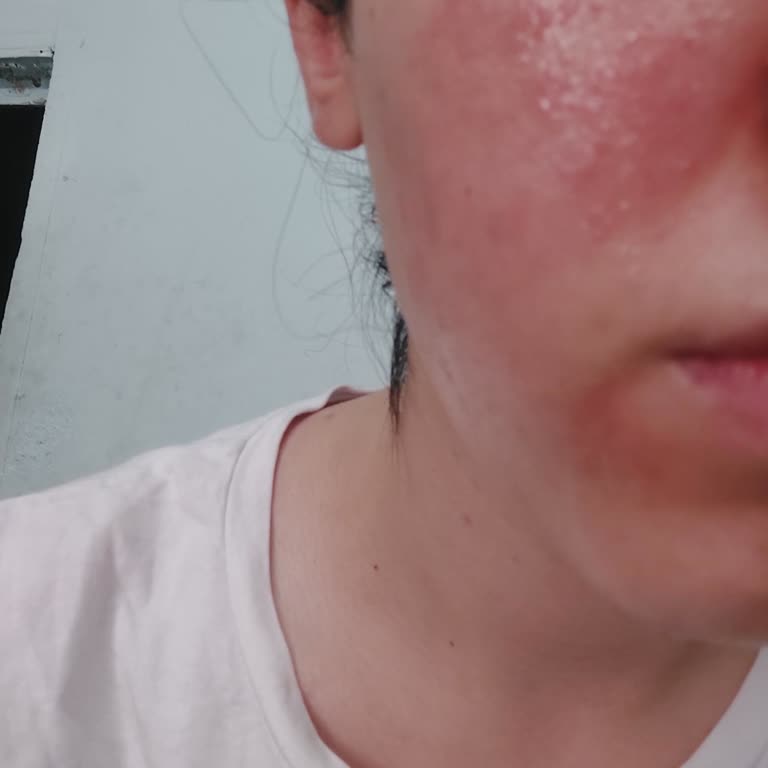 Watsons Frudia Yeşil Güneş Kremi Alerji Yaptı!