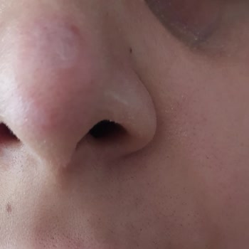 Sayannova Güzellik Lazer Epilasyonda Yüzde Yanıklar