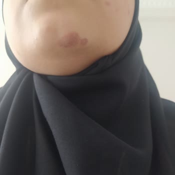 Sayannova Güzellik Lazer Epilasyonda Yüzde Yanıklar